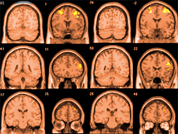 2023-06-brain-scans_tcm7-317760_w1024_n.jpg